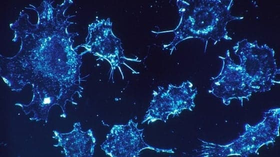 Tumore al pancreas e al colon retto: in 30 anni aumentate incidenza e mortalità