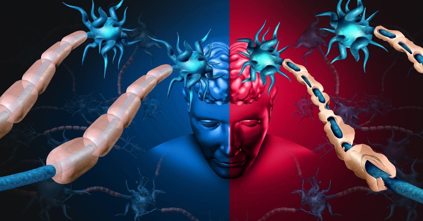 Un farmaco nato per i disturbi del sonno riemerge come candidato contro la sclerosi multipla
