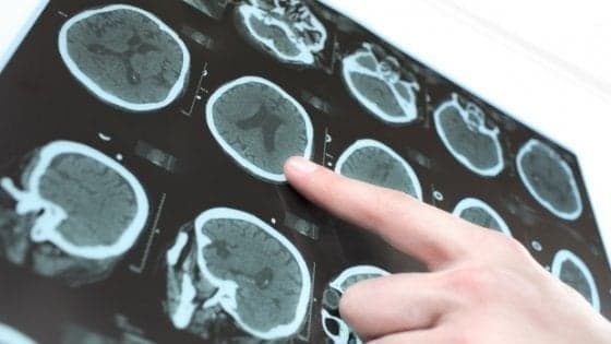 Test promettenti per un farmaco oncologico contro il Parkinson