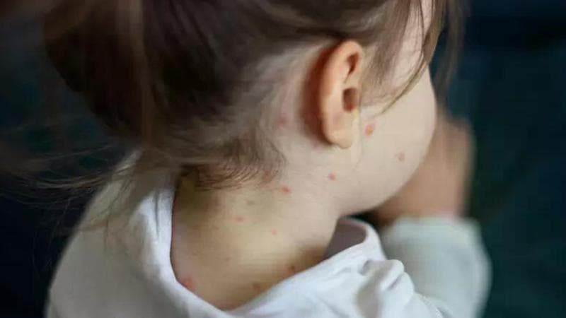 Morbillo, la circolare del ministero: “Casi in aumento, serve campagna vaccinale straordinaria”