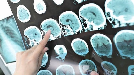 Quasi 1 milione di italiani sono invalidi a causa dell'ictus
