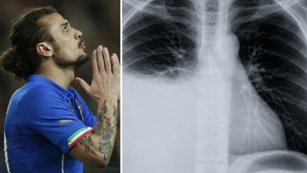 Osvaldo, cos'è il versamento pleurico. Ma ha davvero una relazione col consumo di droghe?
