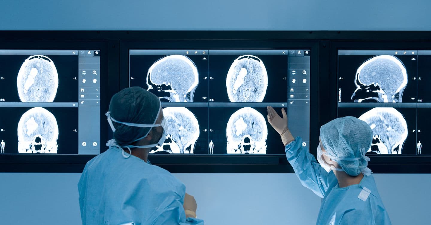 Ictus: l’arteria è riaperta ma il sangue non scorre, l’errore del cervello dopo l’ischemia