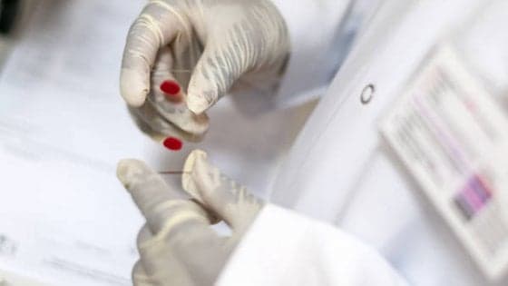 "Un esame del sangue per scoprire il tumore al seno con 5 anni di anticipo"