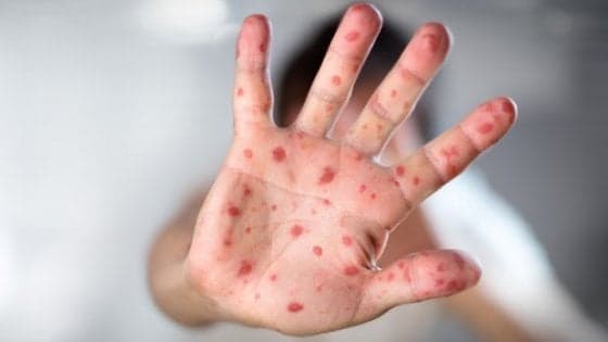 Morbillo, nel 2017 110mila morti. L'Oms: "Aumentati del 30%, per scarsa vaccinazione"
