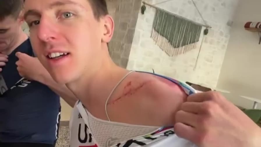 Pogacar in bici per "l'ultimo giorno con la maglia iridata". E mostra la cicatrice: impressionante!