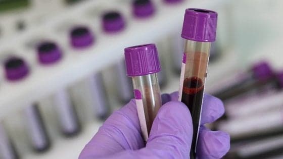 Allo studio test del sangue per la diagnosi precoce del tumore. "Primi risultati incoraggianti"