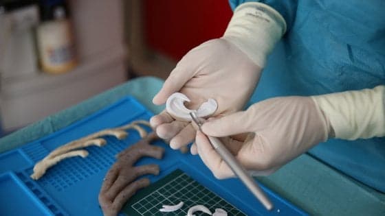 Ricostruito orecchio a un bimbo grazie alla stampa 3D
