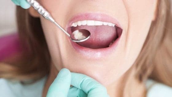 Nelle gengive 'cellule sentinella' che difendono da batteri pericolosi
