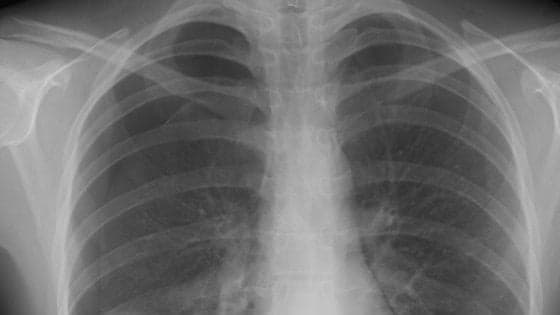Fibrosi polmonare idiopatica, un anticorpo può rallentare la malattia