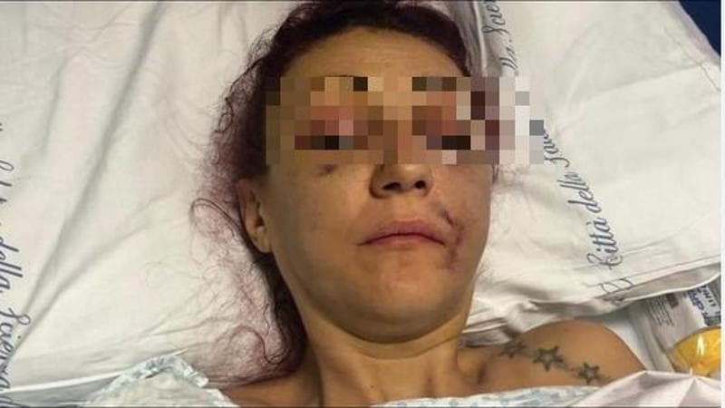Sfigurata dal marito, Parodi (Anm): “La Procura di Torino impugna la sentenza sul caso Regna”